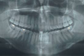 Can-Do-Ability: Finally, A Reason NOT To Go To The Dentist, As Researchers Link Dental X-Rays To Cancer